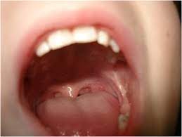 white spot in my mouth