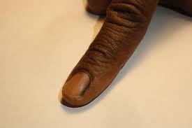 the dermatologist s fingernail