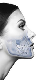 after orthognathic surgery