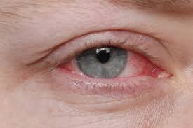 kerais vs conjunctivitis pink eye