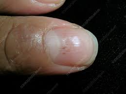 pitted nail due to severe atopic
