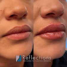 lip filler before and after photos and