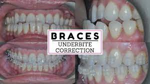 Children, adolescents and young adults will benefit far better from using braces for underbite correction than an older adults. Underbite Is Correcting Braces Progress After A Year Adult Braces Correcting An Underbite Youtube