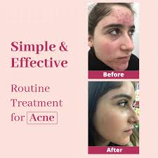 effective routine treatment for acne