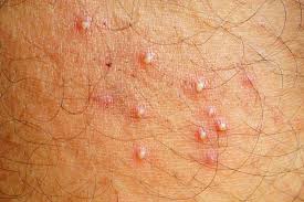 hot tub rash treatment and causes also