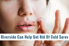 get rid of cold sores with help from