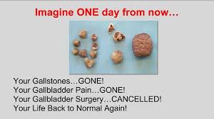 Gallstones Are You Ready For A Change