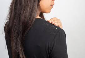 Dandruff During Pregnancy Causes Treatment And Prevention
