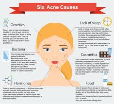 how to treat acne e skin d souza