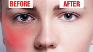 home remes to reduce redness on the
