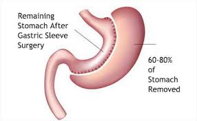 $23,000 is the most often quoted average surgery price. Gastric Sleeve Weight Loss Surgery Turkey Just 2 999 Medaway
