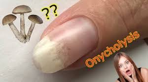 i got onycholysis my nail is lifting