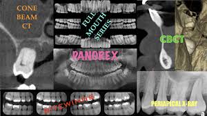 dental x rays periapical panorex