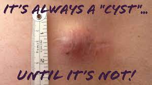 skin cancer sarcoma mimic cyst