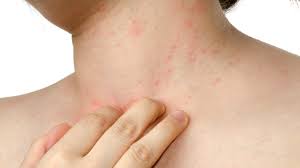 L'allergia alimentare è una forma specifica di avversione ad alimenti o a componenti alimentari (allergeni) che attiva il sistema immunitario o alcuni mediatori cellulari. Allergia Al Peperoncino Sintomi Diavolopiccante