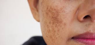 melasma dermatology and skin health