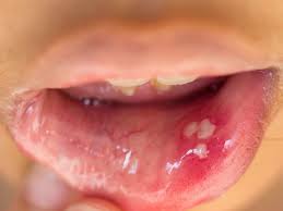 hpv in the mouth symptoms causes and