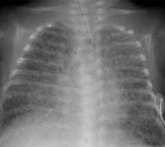 Chests contain items that must be purchased with gold. Lung Disease In Premature Neonates Radiologic Pathologic Correlation Radiographics
