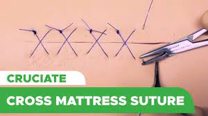 cross mattress suture technique
