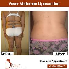 liposuction surgery in lucknow