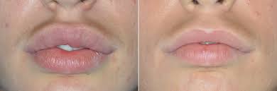 lip reduction surgery miami