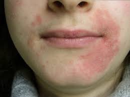 The milia appear in crops, or patches of milia that develop over a period of weeks or months. Skin Bumps That Look Like Pimples But Aren T Insider