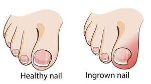 ingrown toenail doctors urgent care