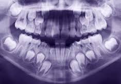 Image result for x ray in children dental