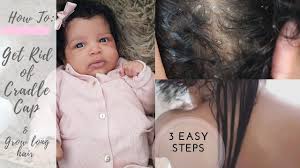 When does baby hair loss occur? How To Get Rid Of Cradle Cap Fast And Grow Long Baby Hair
