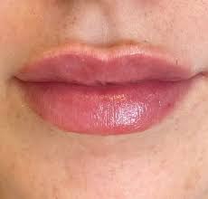 swollen after lip filler
