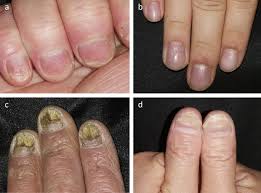 challenge of nail psoriasis an update