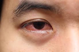what causes mucus in eye eye discharge