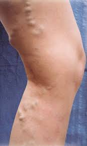 Part of your first visit to vein clinics of america is for us to review your insurance benefits with you. Varicose Vein Treatment In Portland Oregon Pearl Women S Center Pearl Women S Center
