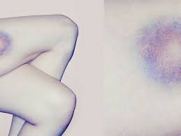 bruise easily 8 facts you need to know