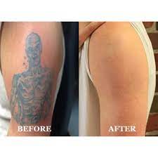 laser tattoo removal at rs 600 session