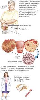 But in rare cases, ovarian tumors can grow much larger. Ovarian Cancer Spectrum Health