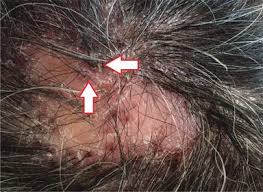 infestations and neoplasms of the scalp