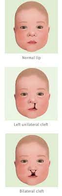 cleft lip and palate best treatment at