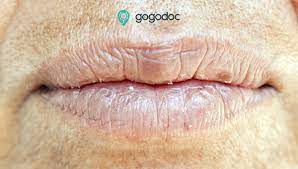 dry lips causes symptoms and