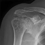 Image result for icd 10 code for rotator cuff arthropathy