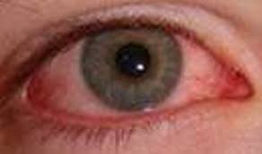 herpes infection really cause blindness