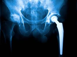 diffe types of hip replacement