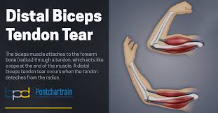 distal biceps tendon tear brandon p