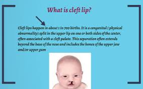 es with cleft lip cheiloschisis