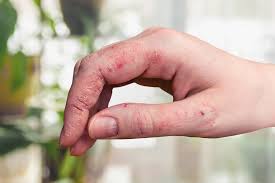 tackling chronic hand eczema