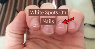 what is white spots on nails easy