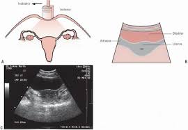 A pelvic ultrasound may be ordered by your physician to get a detailed look at the pelvic organs including the uterus, cervix, ovaries, and fallopian tubes. Pelvic Ultrasound In The Nongravid Patient Radiology Key