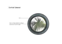 Types Of Cataracts Cataract Surgery Information