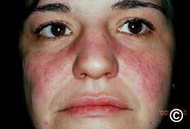 do you have lupus symptoms causes and