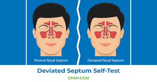 deviated septum self test how to test